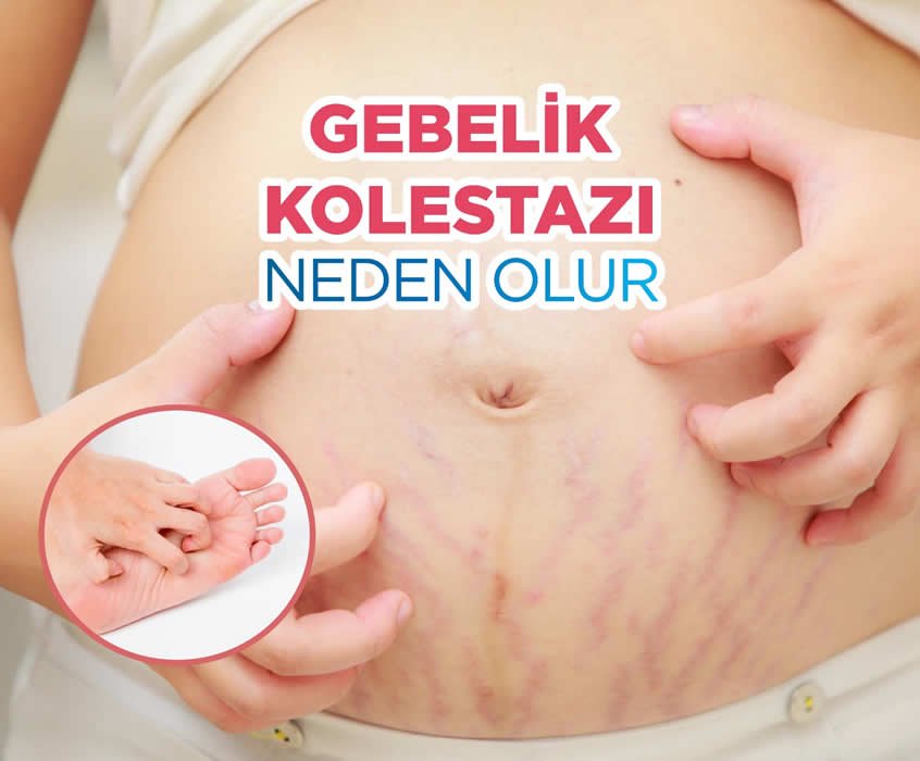 Gebelik kolestazı
